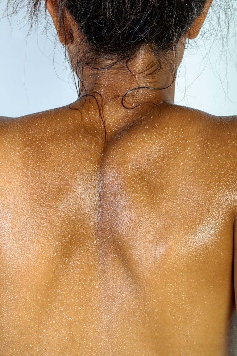 EXCESSIVE SWEATING