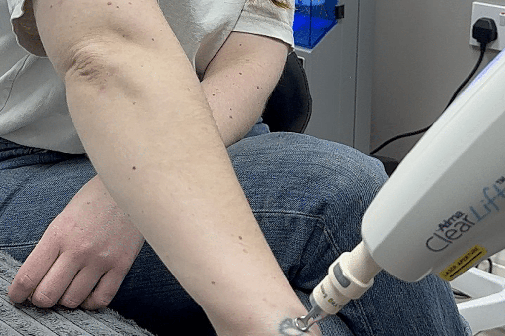 Tatoo removal 1